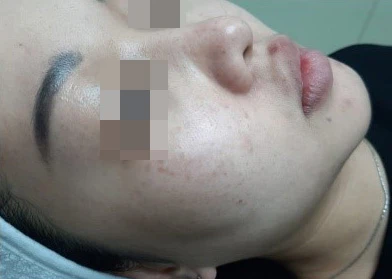 Acless spot peel
