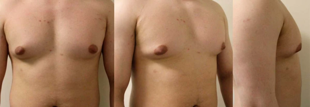 do_mastektomii_DEKA-SmartLipo
