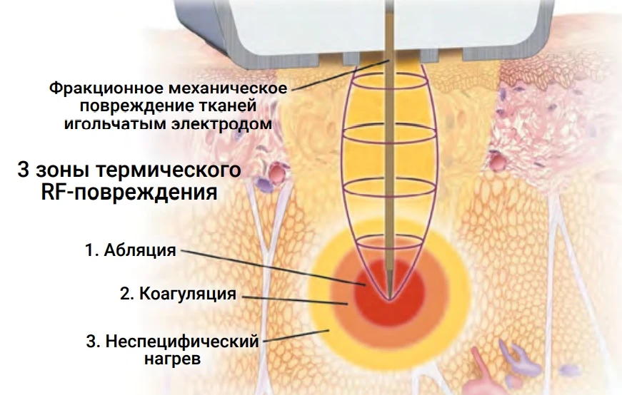 Fractora, InMode
