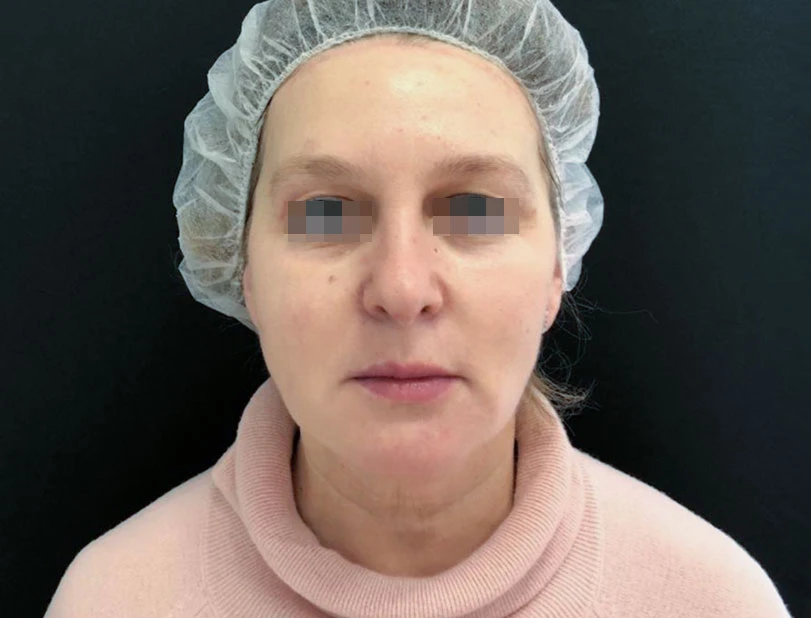 Сочетанное применение Ultherapy и филлерной коррекции