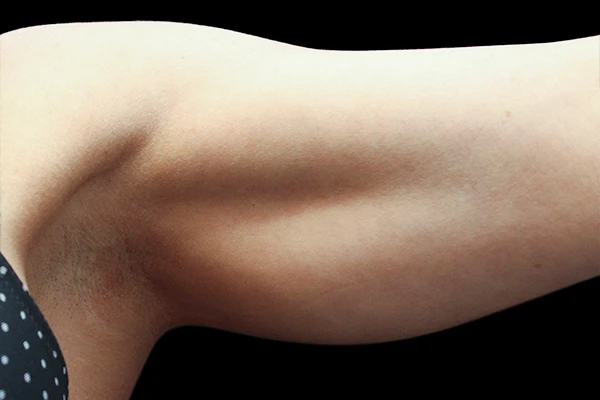 Зона рук после процедуры на аппарате Exilis Ultra 360™