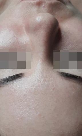 Acless spot peel