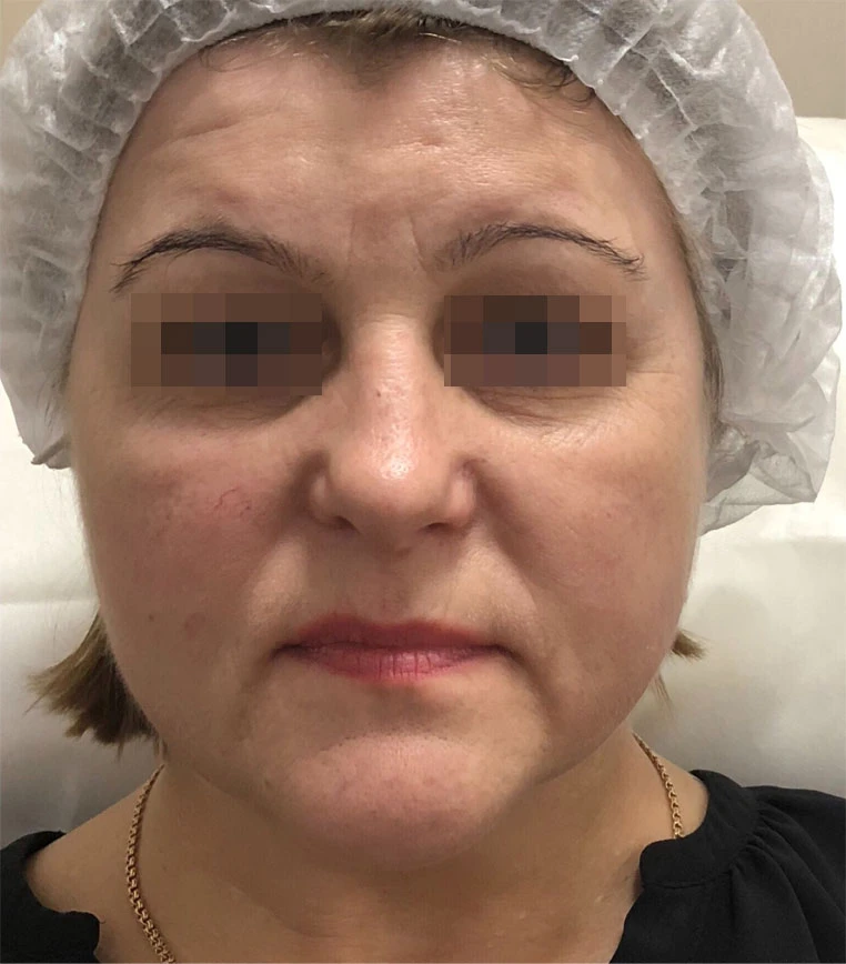 Сочетанное применение Ultherapy, филлерной и БТА коррекции