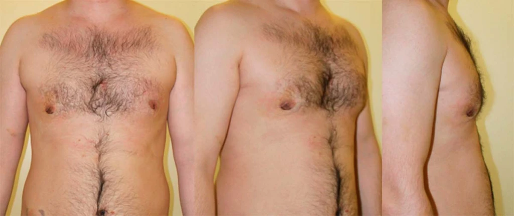 posle_mastektomii_DEKA-SmartLipo
