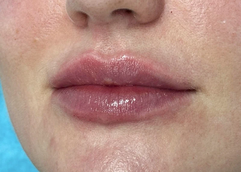 Аугментация губ препаратом Neauvia Lips