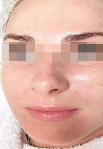 Acless spot peel