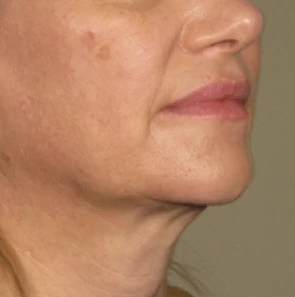 Фото после процедуры Ultherapy