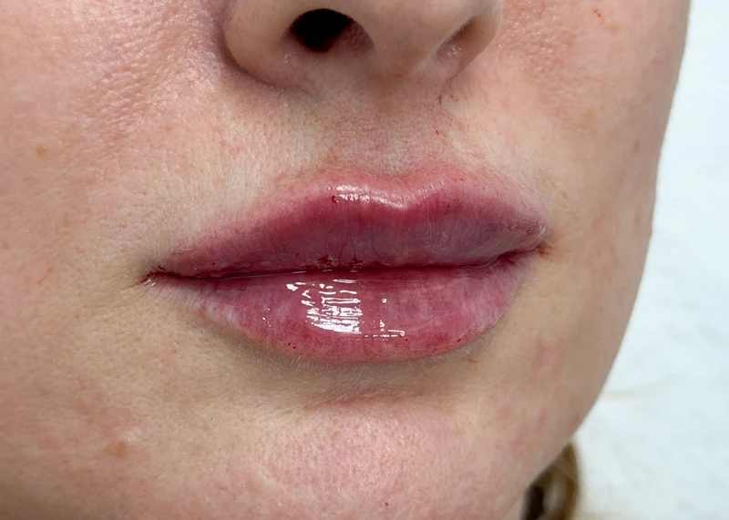 Аугментация губ препаратом Neauvia Lips
