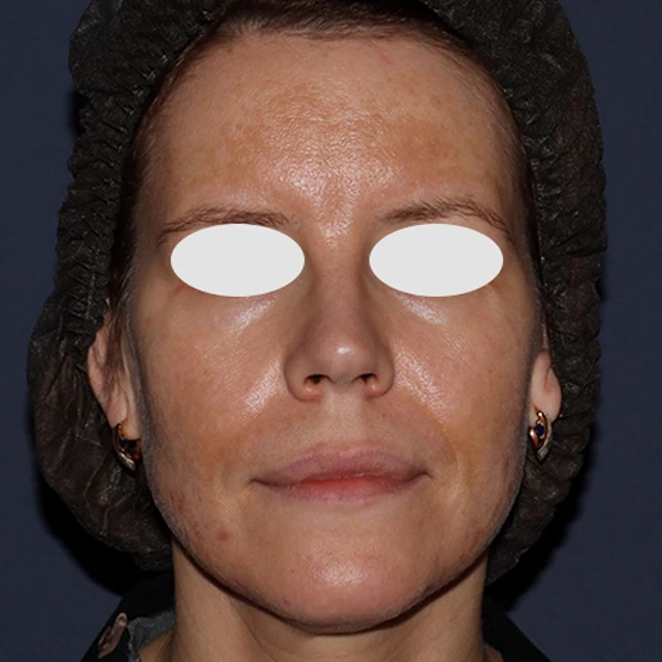 iXtron Fractional