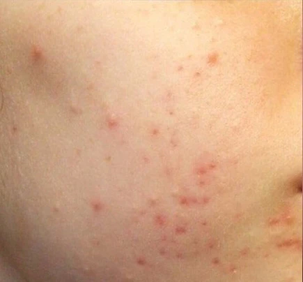 Acless spot peel