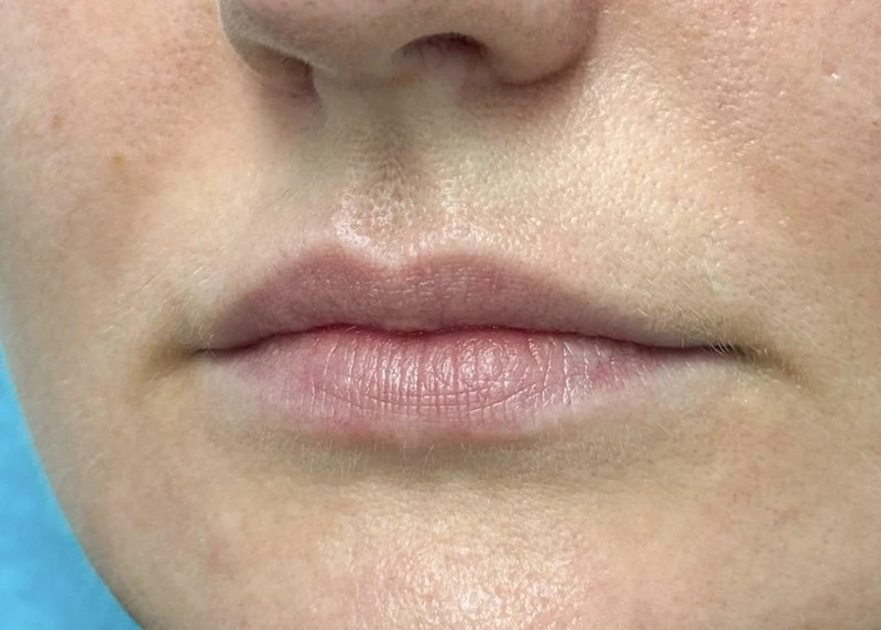 Аугментация губ препаратом Neauvia Lips
