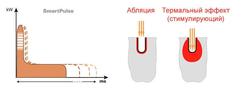 Форма импульса SmartPulse™