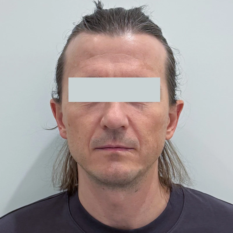RF и HIFES на аппарате Emface
