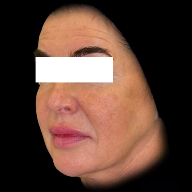 Ultra Skin Solution