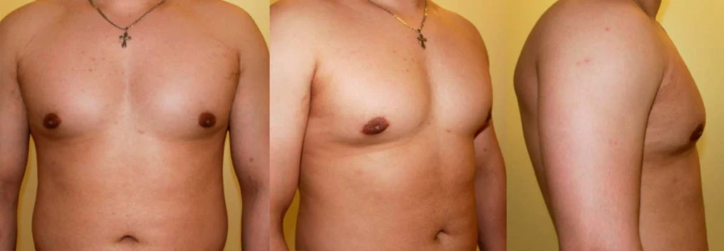 posle_mastektomii_DEKA-SmartLipo