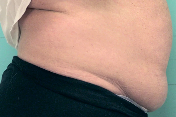 Зона живота до процедуры на аппарате Exilis Ultra 360™