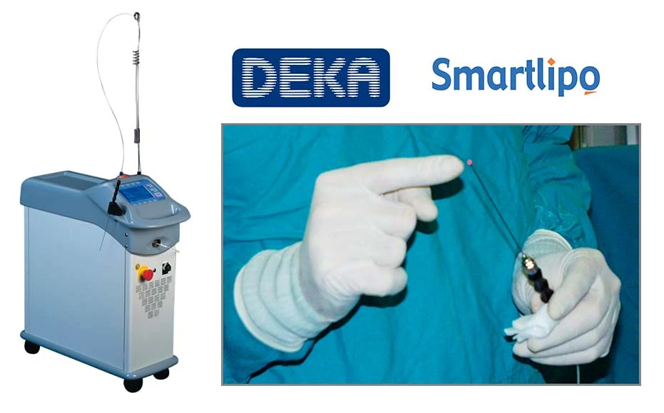 lazer_DEKA-SmartLipo
