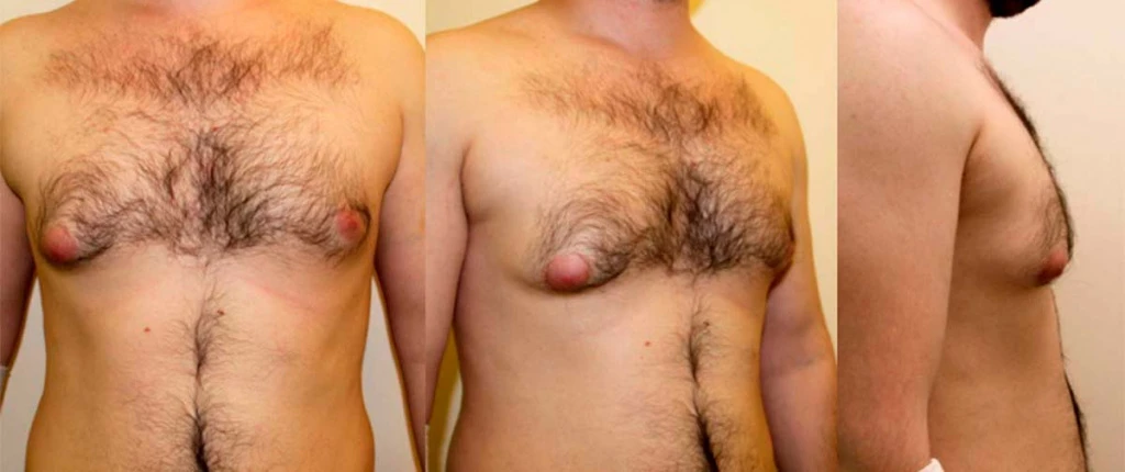 do_mastektomii_DEKA-SmartLipo