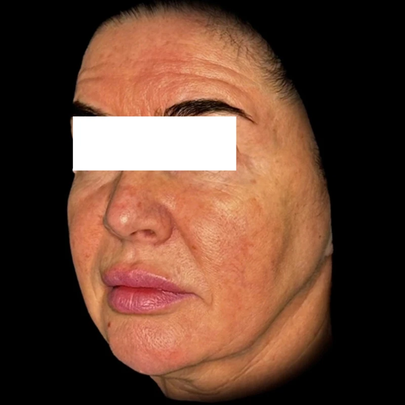 Ultra Skin Solution
