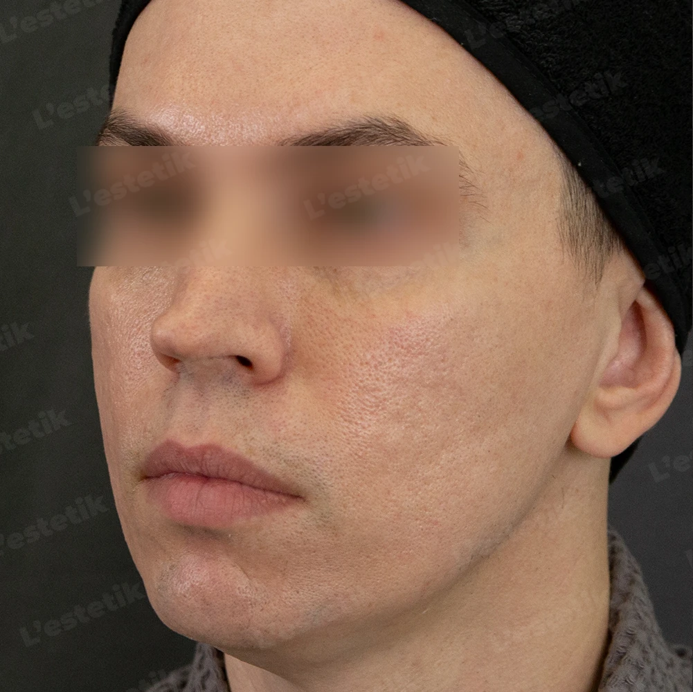 После