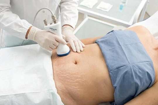 Biodermogenesi®: бережная регенерация против стрий и рубцов